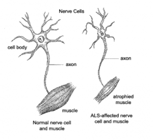 Nerve fibers ALS